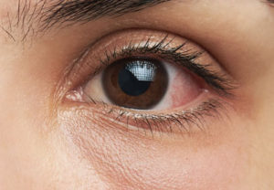 eye-care-Allergy-Eyes