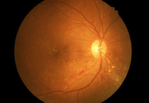 eye-care-Diabetic-Eye