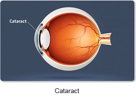 cataract