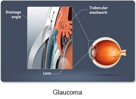 glaucoma