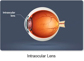 image_intraocular