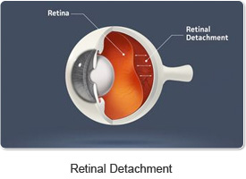 retinal_detachment